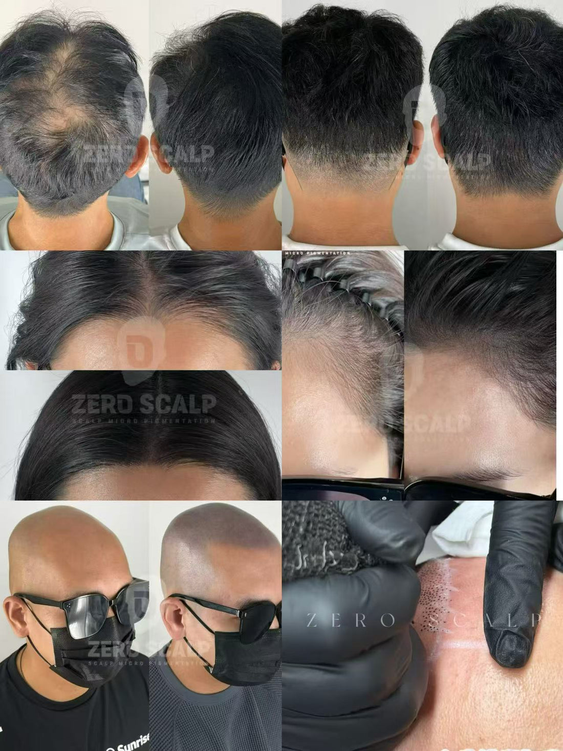 What is SMP (Scalp Micropigmentation)? A Complete Guide for 2026